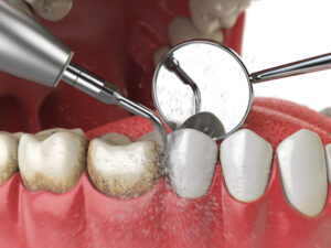 Read more about the article How to Remove Calcium Deposits on Teeth?