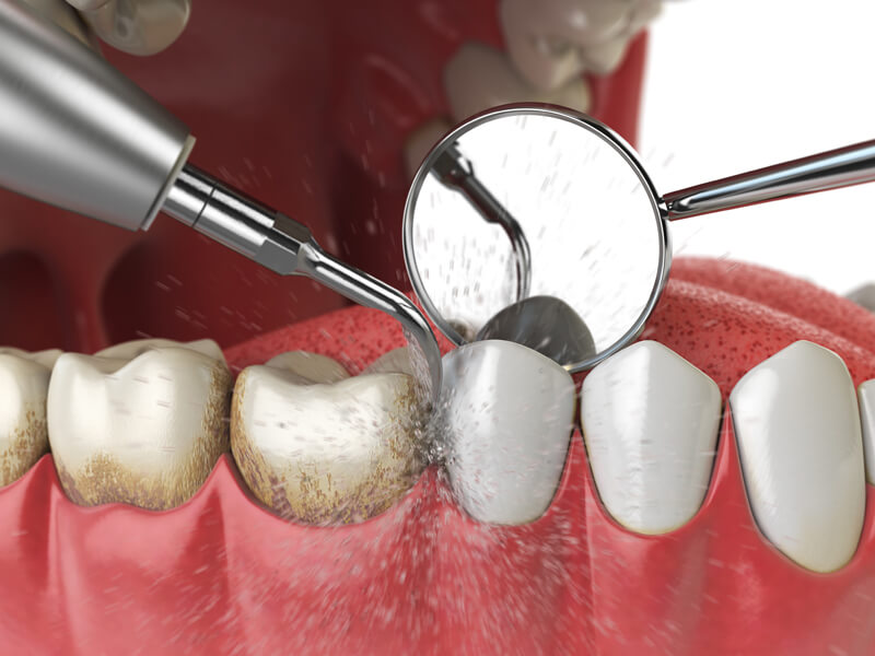 You are currently viewing How to Remove Calcium Deposits on Teeth?