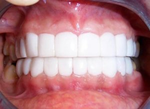 Read more about the article Chiclet Teeth – What Is It and Why Do People Get It?￼