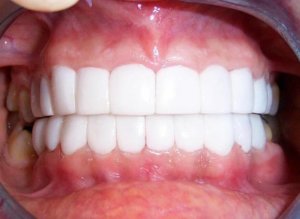 Chiclet Teeth – What Is It and Why Do People Get It? - Teethandtooth