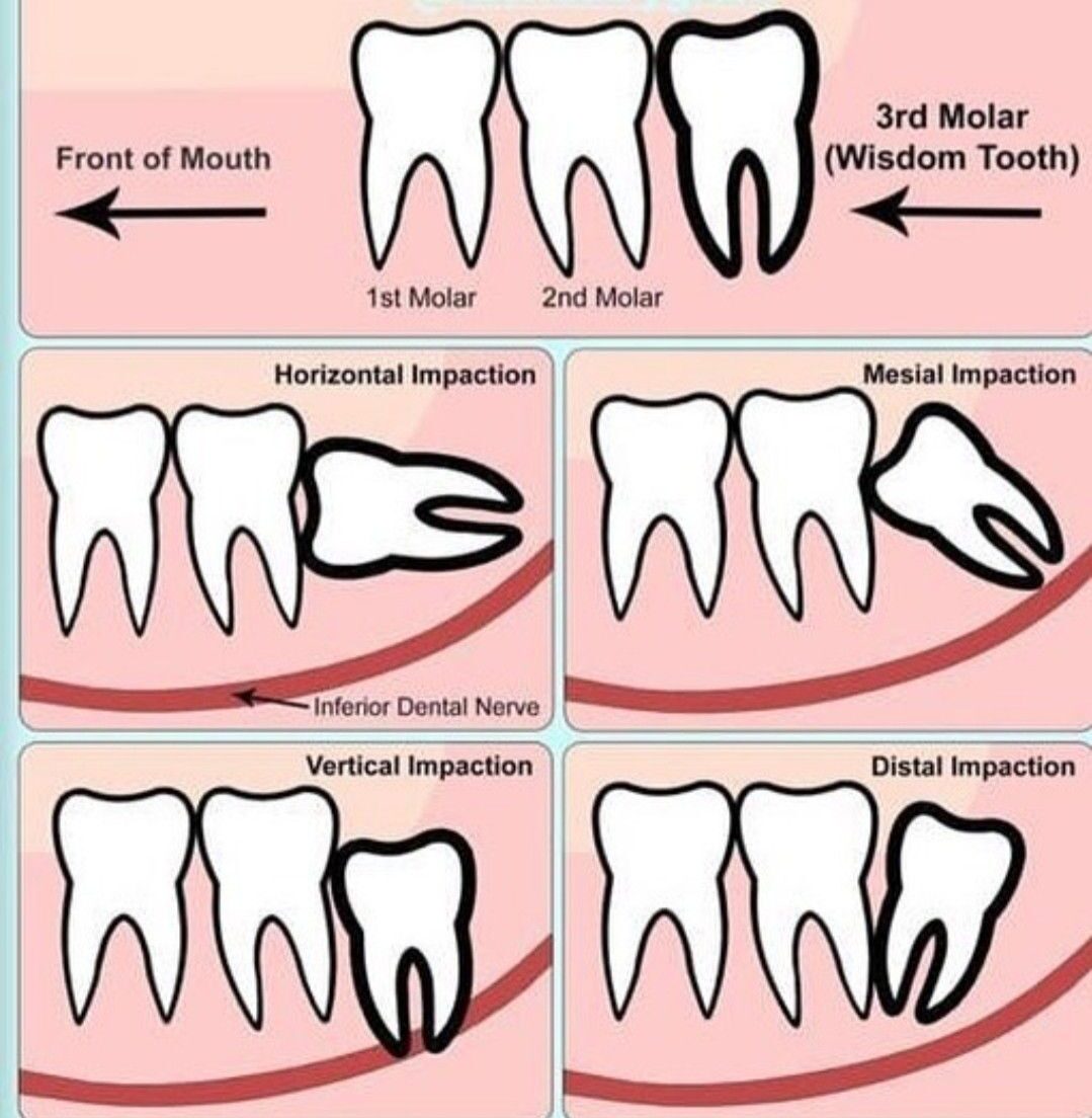 Horizontal Impacted Wisdom Tooth: Why It Happens and Should I Remove It ...