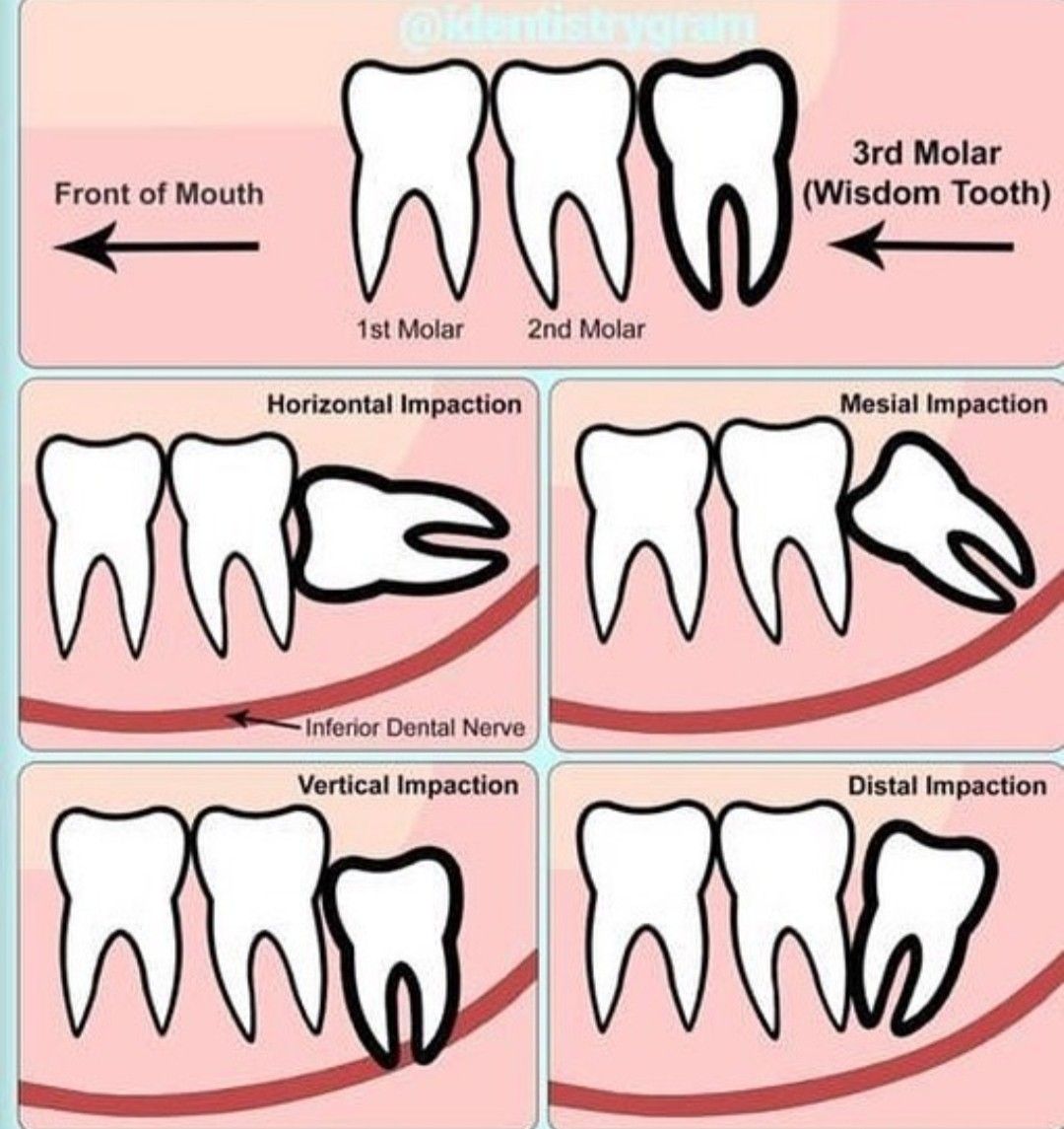 Treatments for Wisdom Tooth Filling vs Extraction Teethandtooth
