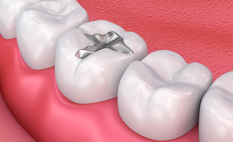 You are currently viewing Treatments for Wisdom Tooth: Filling vs Extraction