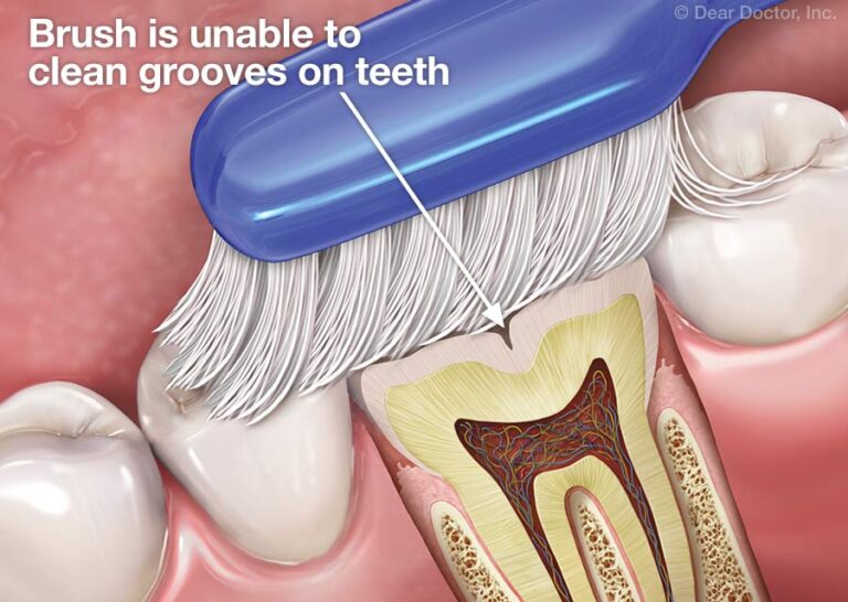All You Need to Know About Deep Grooves in Teeth Teethandtooth