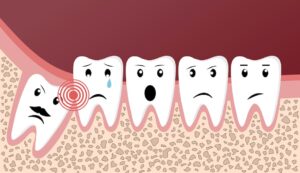 Read more about the article What Are the Benefits of Keeping Wisdom Teeth?