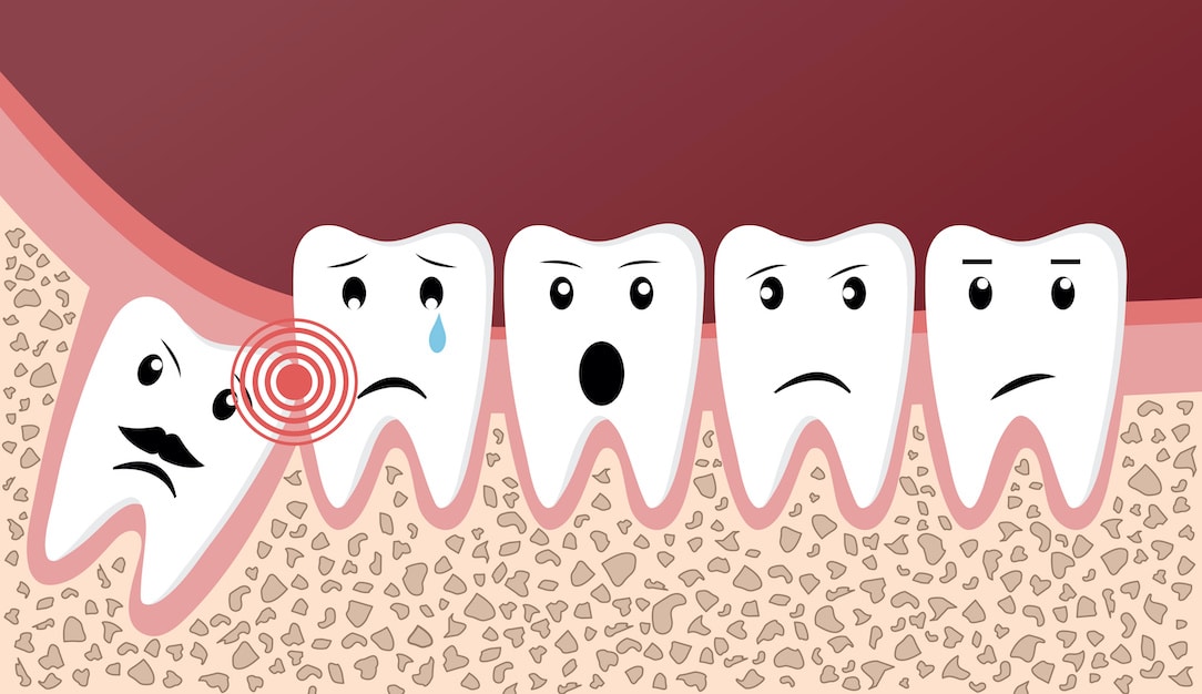 You are currently viewing What Are the Benefits of Keeping Wisdom Teeth?