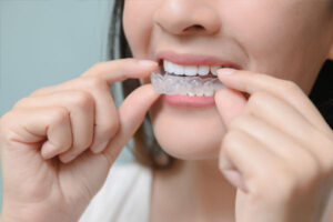 Read more about the article When Can I Wear My Retainer After Wisdom Teeth Removal?