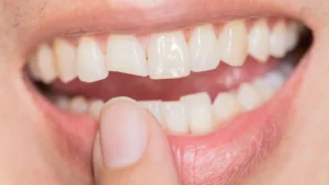 Read more about the article Dental Wax for Broken Tooth. Will It Work and Where to Buy?