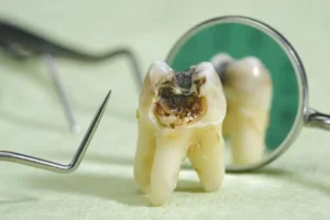 Read more about the article What Is Black Wisdom Tooth and Why Is It Happening?