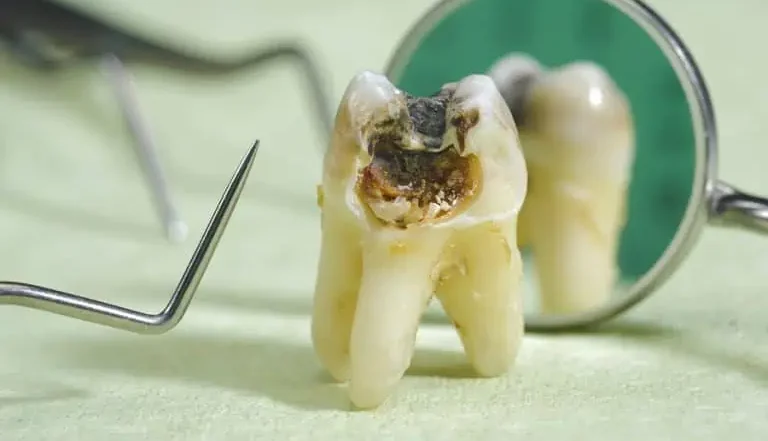 Black Wisdom Tooth: Causes and Treatment