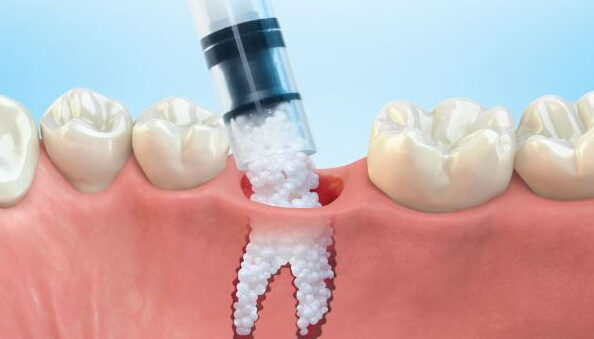 Read more about the article Bone Graft After Wisdom Teeth Removal. Why and How Is It Done.