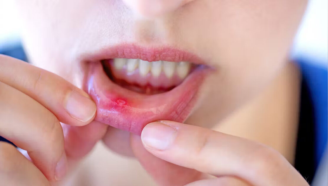 You are currently viewing Canker Sore After Wisdom Teeth Removal. Causes, Treatments, and Prevention