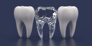 Read more about the article All You Need to Know About Diamond Tooth Dental Implants