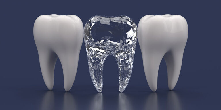 All You Need To Know About Diamond Tooth Dental Implants Teethandtooth