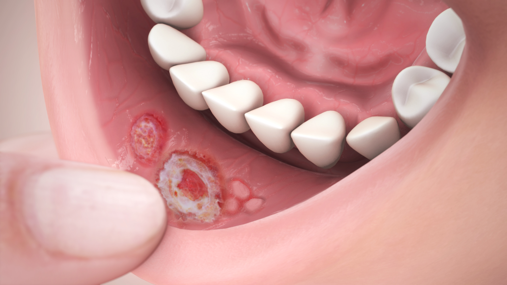 Canker Sore After Wisdom Teeth Removal