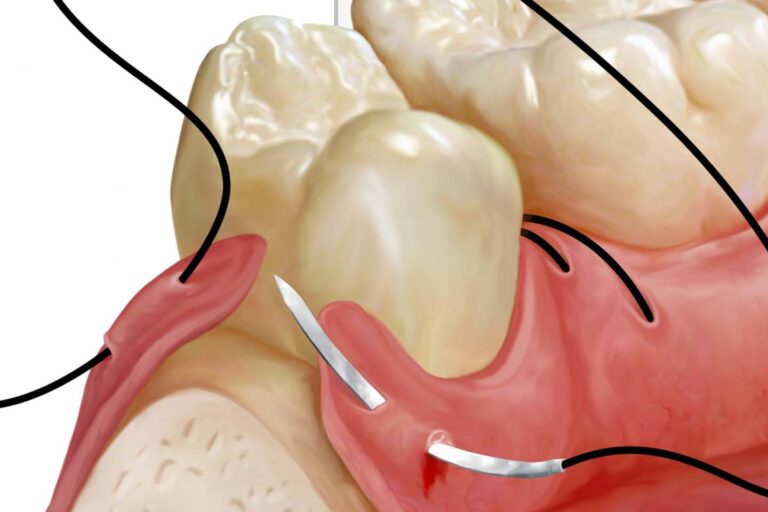 When Do Wisdom Teeth Stitches Dissolve and How? Teethandtooth