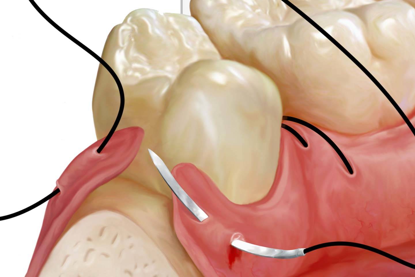 You are currently viewing When Do Wisdom Teeth Stitches Dissolve and How?