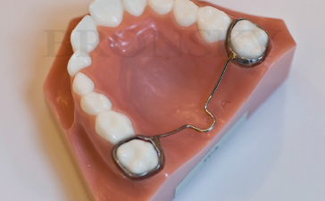 transpalatal arch tooth spacer