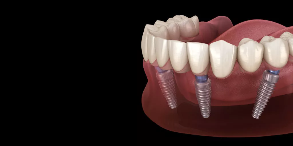 You are currently viewing The 10 Truth About Dental Implants That You Need to Know