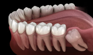 Read more about the article Can Wisdom Teeth Grow Back After Being Extracted?