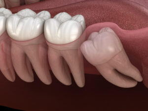 Read more about the article Do I Need My Wisdom Teeth Removed? Take This Quiz to Find Out!