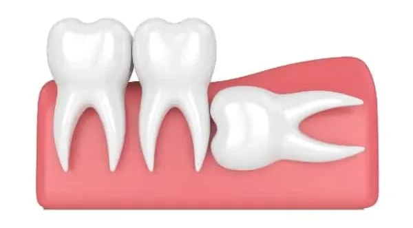 You are currently viewing Horizontal Impacted Wisdom Tooth: Why It Happens and Should I Remove It?