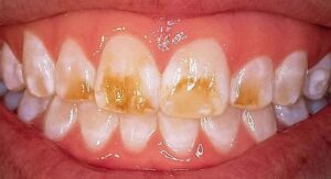 Read more about the article Hypocalcification of Teeth: Causes, Symptoms, Treatments