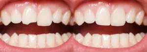 Read more about the article Teeth Bonding Before and After Pictures and Differences