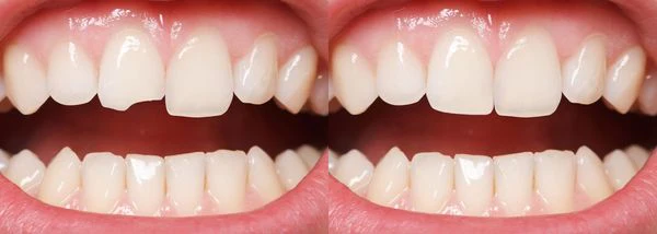 You are currently viewing Teeth Bonding Before and After Pictures and Differences