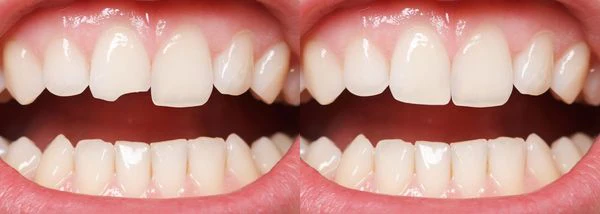 Read more about the article Teeth Bonding Before and After Pictures and Differences