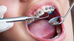 Read more about the article Can You Actually Get Your Teeth Cleaned With Braces?