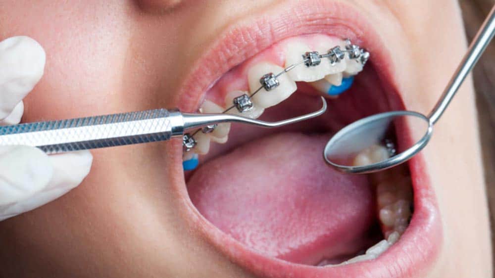 Read more about the article Can You Actually Get Your Teeth Cleaned With Braces?