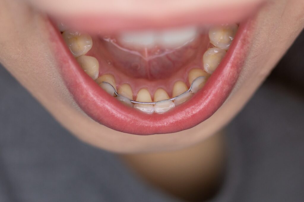 When Can I Wear My Retainer After Wisdom Teeth Removal? - Teethandtooth