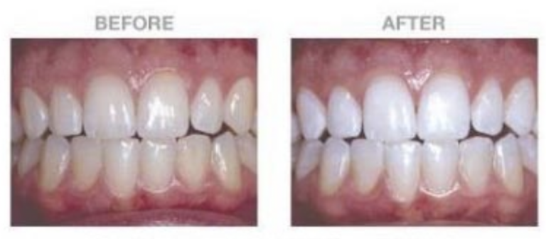 Opalescence Boost Teeth Whitening How It Works And How Much It Costs