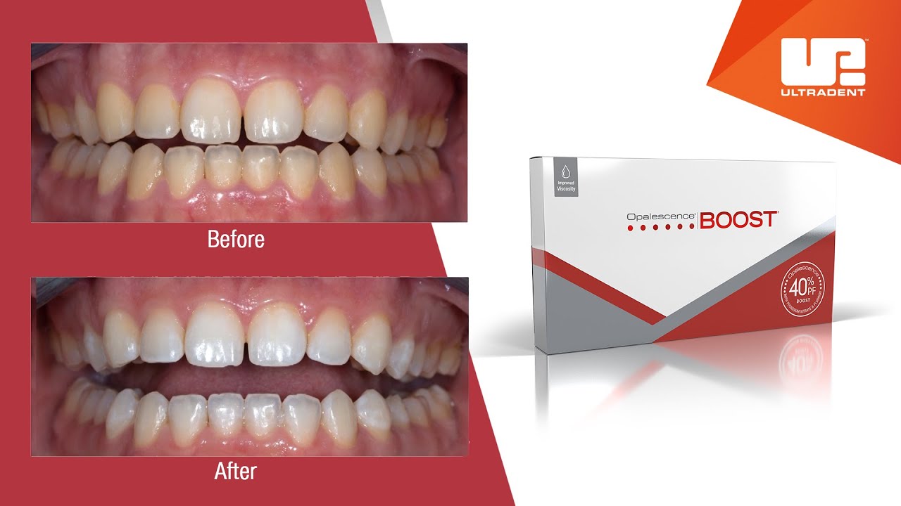 You are currently viewing Opalescence Boost Teeth Whitening: How it Works and How Much it Costs