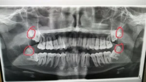 Read more about the article Is It Possible to Have 8 Wisdom Teeth and Why?