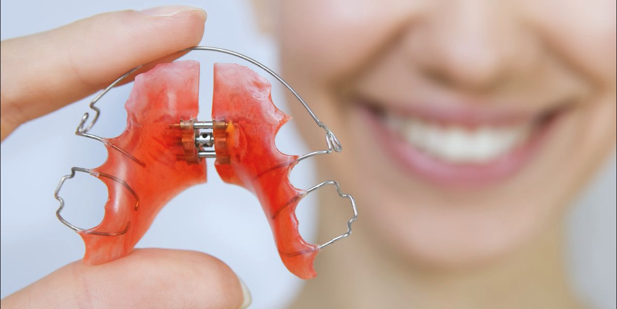 Read more about the article All You Need to Know About Palate Expander: How It Works and Frequently Asked Questions
