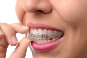 Read more about the article How to DIY Your Homemade Mouth Guard for Sleeping