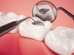You are currently viewing What Are the Do’s and Don’ts After Dental Fillings?