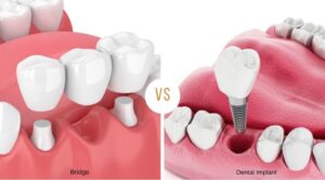 Read more about the article Dental Bridge vs Implant: Similarities, Differences, and Which Is the Best?