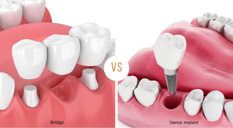 You are currently viewing Dental Bridge vs Implant: Similarities, Differences, and Which Is the Best?