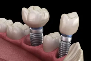 Read more about the article 10 Important Tips to Care for Dental Implants
