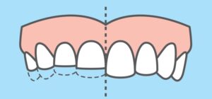 Read more about the article Effects of Bruxism: Before and After Teeth Grinding