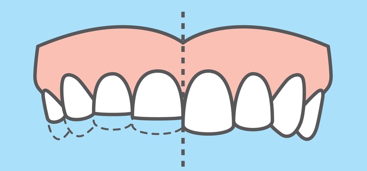 You are currently viewing Effects of Bruxism: Before and After Teeth Grinding